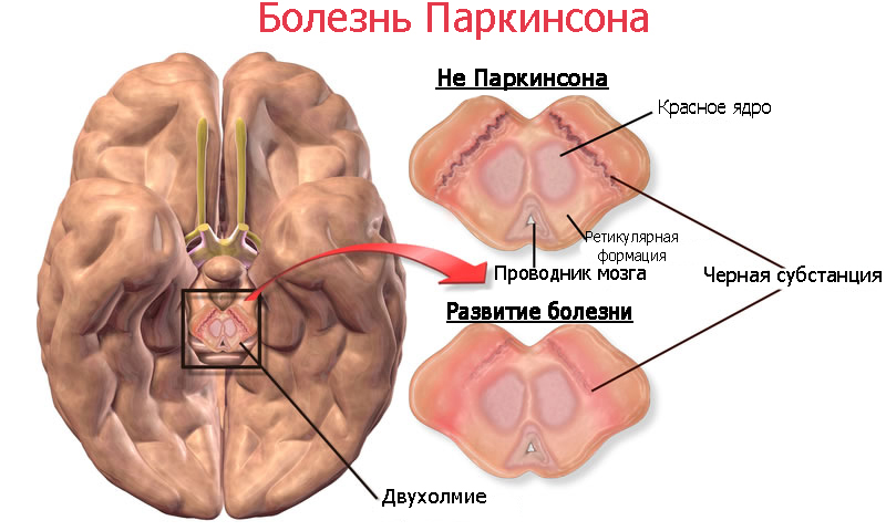 Что такое болезнь Паркинсона — Центр экстрапирамидных и когнитивных  расстройств